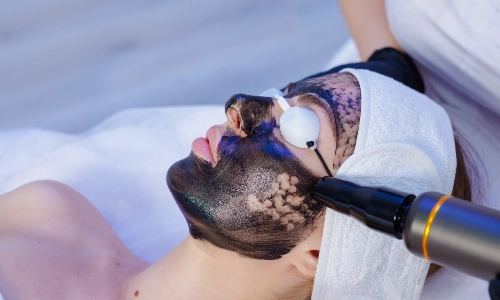 Carbon Facial, Petals Health Carbon Facial, Petals Health