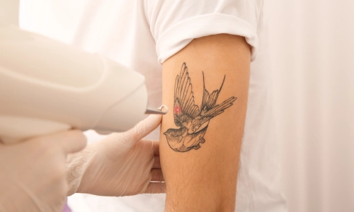 Tattoo Removal, Petals Health Tattoo Removal, Petals Health