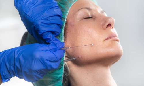 Thread Lifts, Petals Health Thread Lifts, Petals Health