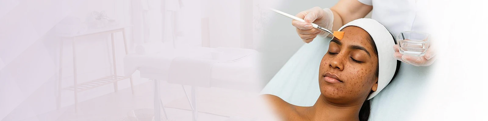 Chemical Peel Treatment