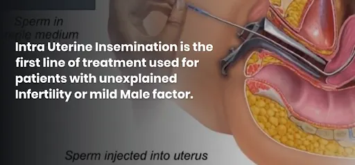 IUI vs IVF difference